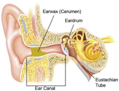 occluded cerumen vs impacted